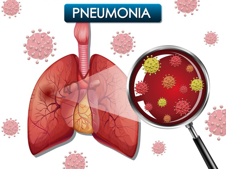 Alt= gejala, penyebab dan mencegah pneumonia