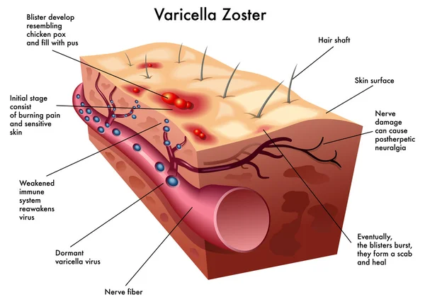 alt= virus varicella-zoster