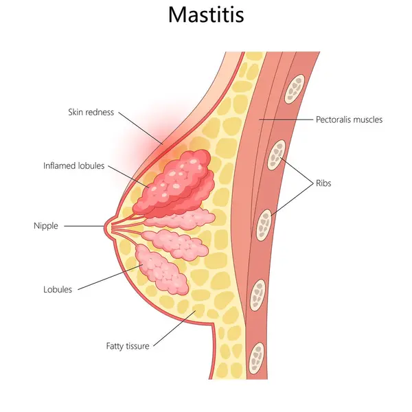 alt=mastitis,