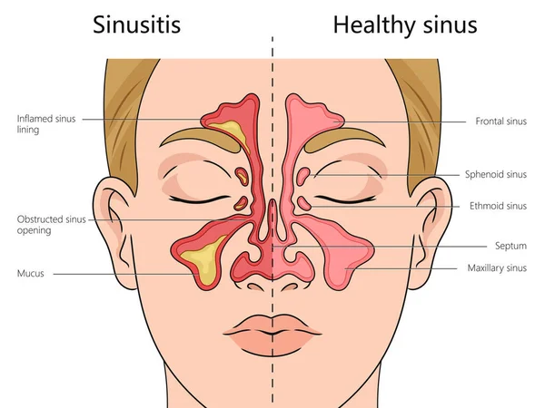 alt= sinusitis