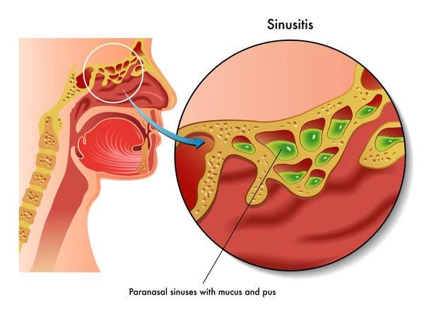 Alt= sinusitis