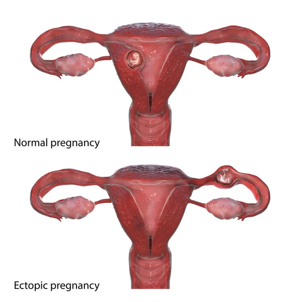 alt= hamil di luar kandungan